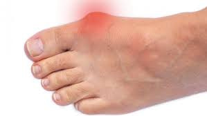 Bunions are deformities that typically form at the base of the big toe. The red area show where people experience pain.