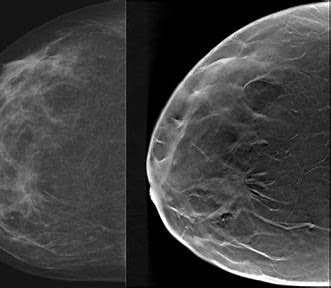 3D Mammography | Indiana Regional Imaging